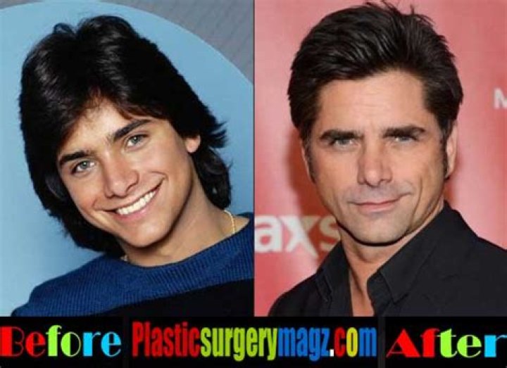 John Stamos Plastic Surgery, Before And After – Health Update And Age